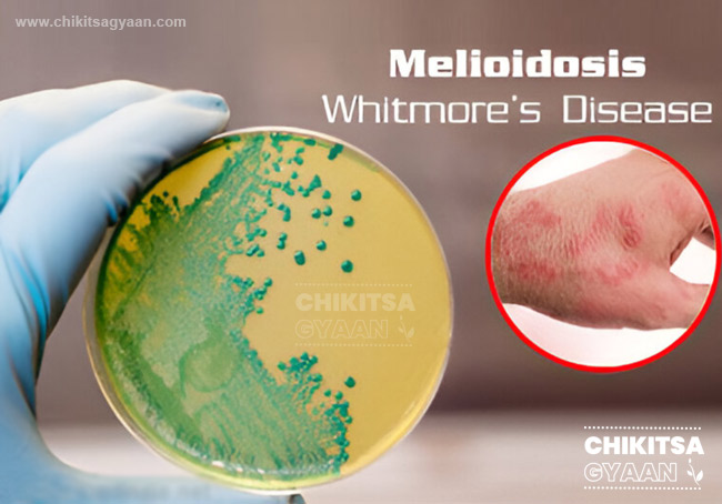 Melioidosis – The Emerging Threat in India