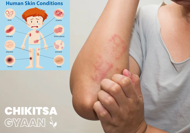 Urticaria Prevention Tips