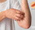 What is Urticaria? Causes, Symptoms, Prevention, and Home Remedies