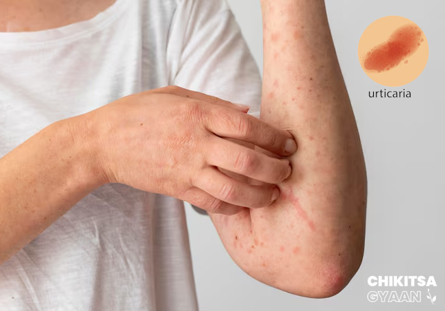 What is Urticaria? Causes, Symptoms, Prevention, and Home Remedies