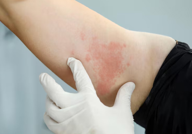 What is Urticaria? Causes, Symptoms, Prevention, and Home Remedies