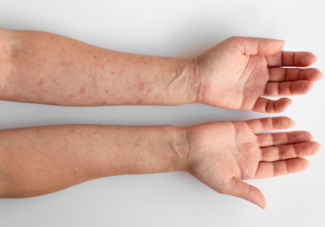 What is Urticaria? Causes, Symptoms, Prevention, and Home Remedies