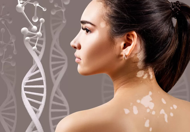 What is Vitiligo (White Patches)?