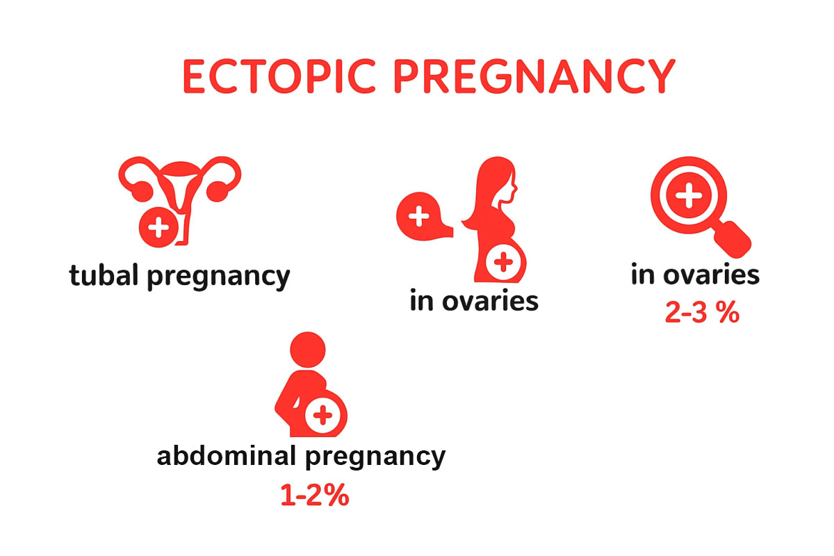 How to Reduce the Risk of Ectopic Pregnancy